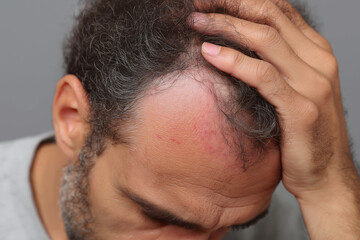 Fototapeta premium Irritated scalp redness close up man hand hairline skin condition discomfort