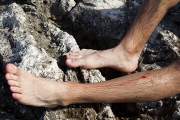 Male legs on rocks with a scratch on the shin. The scene illustrates a skin injury sustained in natural conditions, symbolizing the danger of sharp surfaces.