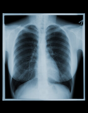 X-ray image of human chest taken to examine the lungs 