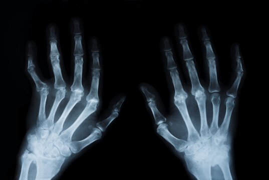 X-ray hands, front view. Medical examination, x-ray for medical diagnosis 