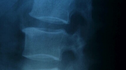 radiologist analyzing cervical spine x-ray of a patient with spinal chronic pain. Closeup shot of patient's skull MRI x ray scan results at medical clinic. - Powered by Adobe