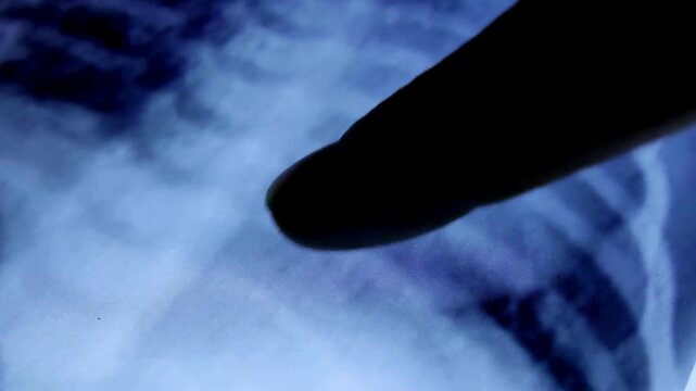 A medical worker in a hospital analyzes x-ray scan of patient's spinal injury. Closeup of Doctor hands with medical x ray of spine scan on light background.