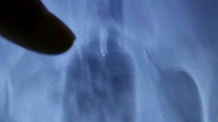 A medical worker in a hospital analyzes x-ray scan of patient's spinal injury. Closeup of Doctor hands with medical x ray of spine scan on light background. - Powered by Adobe