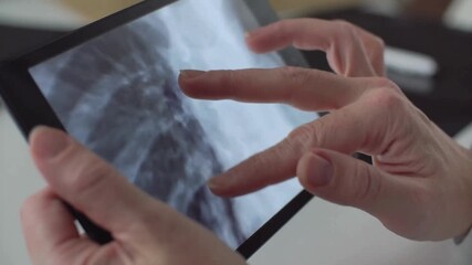 radiologist analyzing CT scan of a patient's lungs in hospital office. doctor medical examining x-ray of patient lungs on digital tablet screen, closeup. - Powered by Adobe
