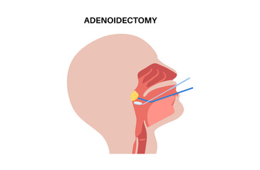 Adenoidectomy medical procedure