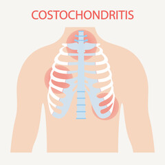 Flat vector illustration of costochondritis showing chest pain, tenderness near the sternum, swelling. Highlights similarities with heart attack and Tietze syndrome for visual comparison. icon