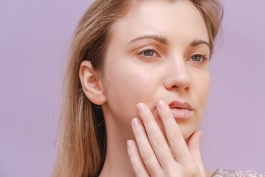 Closeup of young woman with herpes cold sore on mouth against purple background. Herpes blisters