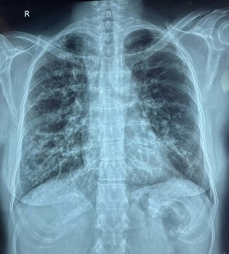 Chest X-ray of a patient with bronchiectasis