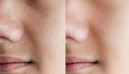 Before and after treatment of dry skin, large pores on a male face. Visible improvement in texture...