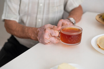 Vitiligo on the hands of an elderly man. Close-up of a man's hands holding a cup of tea. Autoimmune disease