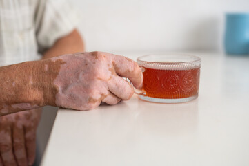 Vitiligo on the hands of an elderly man. Close-up of a man's hands holding a cup of tea. Autoimmune disease