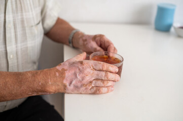 Vitiligo on the hands of an elderly man. Close-up of a man's hands holding a cup of tea. Autoimmune disease