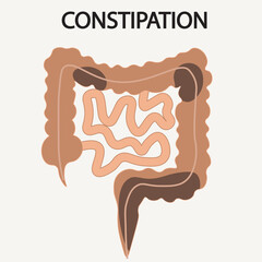 Flat vector illustration of constipation, showing bloating, strain, and hard stools. Highlights abdominal pain and discomfort, often confused with IBS or bowel obstruction.