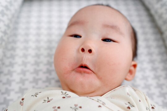 よだれかぶれで口周りが赤くなった5ヶ月の女の子の赤ちゃん