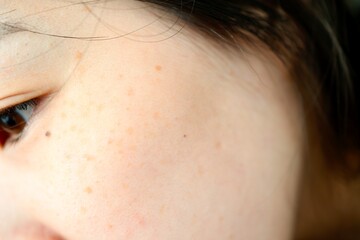 女性の頬に見える肝斑の拡大写真