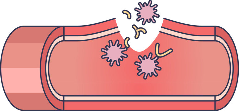 Illustration of a damaged blood vessel with insufficient platelets, failing to form a clot. Represents bleeding disorders and impaired hemostasis due to clot underproduction.