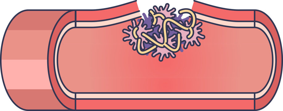 Diagram of a fibrin mesh and platelets sealing a ruptured blood vessel. This visualizes the coagulation cascade, forming a clot to stop bleeding and begin tissue repair.