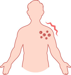 Fototapeta premium An illustration of a person with a painful skin rash and blisters on their chest, representing a severe idiosyncratic reaction or adverse drug event.