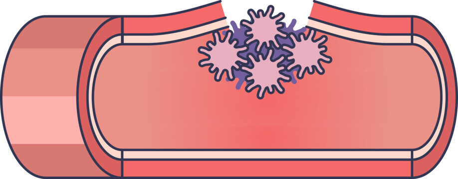 A medical illustration of platelet plug formation. Activated platelets (thrombocytes) are shown aggregating at the site of an injury in a blood vessel wall to initiate hemostasis.