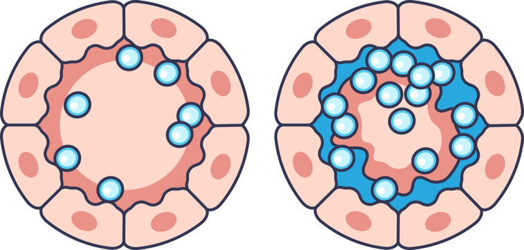 Medical illustration comparing normal and excessive airway mucus secretion. The right side shows hypersecretion from epithelial cells, leading to mucus buildup and airway obstruction.