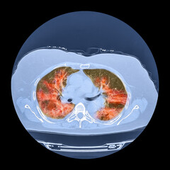 Lungs affected by Covid-19 pneumonia, CT scan