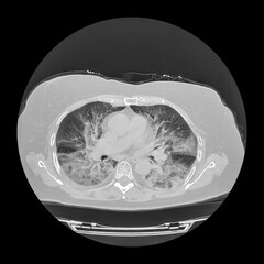 Lungs affected by Covid-19 pneumonia, CT scan