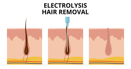 Electrolysis hair removal process showing probe inserting into hair follicle