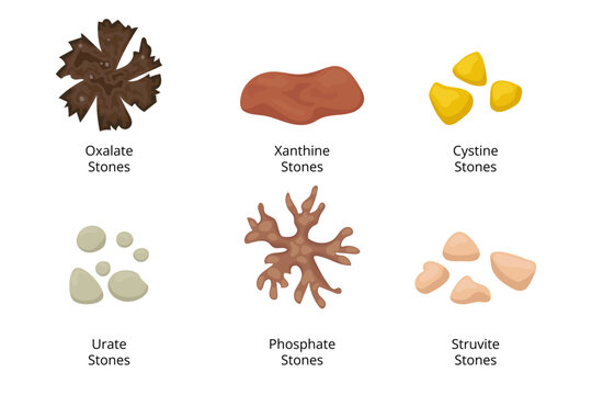 Different types of kidney stones forming in the urinary tract
