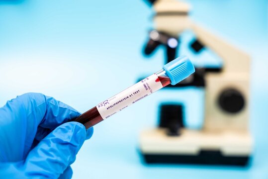 Evaluates apolipoprotein A1 levels, important for assessing