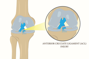 Medical illustration of anterior cruciate ligament (ACL) tear showing knee joint injury detail. eps 10