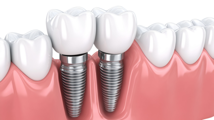 Dental Implants with Teeth in Gums for Tooth Replacement and Oral Health on a Transparent Background