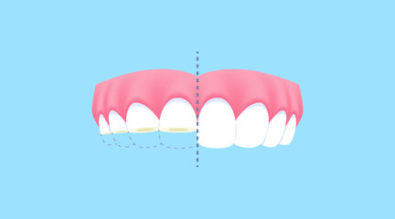 Upper teeth - Attrition (Before and After Comparison) illustration vector design. Dental care concept.