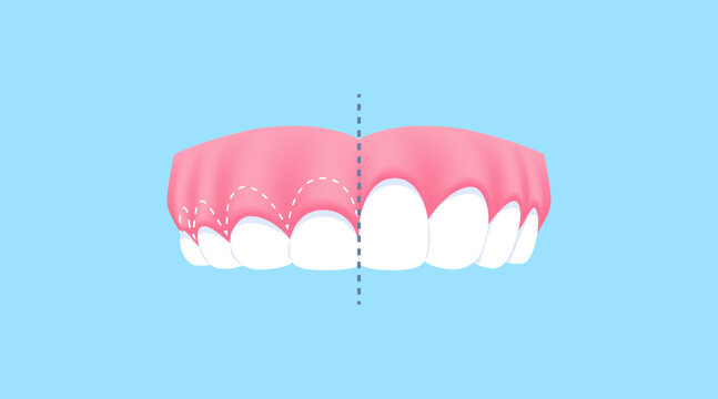 Upper teeth - Gummy Smile (Before and After Comparison) illustration vector design. Dental care concept.