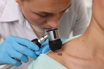 Doctor examining young woman's mole with dermatoscope in hospital, closeup
