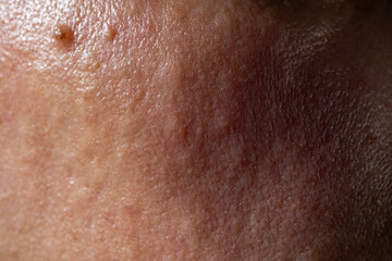 Fototapeta premium Woman's skin after subcutaneous injections to smooth out wrinkles.
