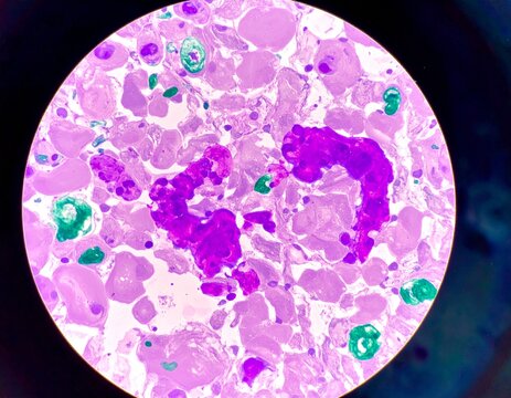 Microscopic view of a bone marrow smear showing large, purple-stained Gaucher cells with their characteristic wrinkled cytoplasm.