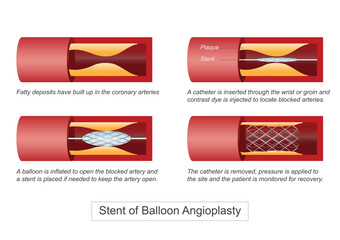 Balloon angioplasty is a minimally invasive procedure to widen narrowed or blocked arteries