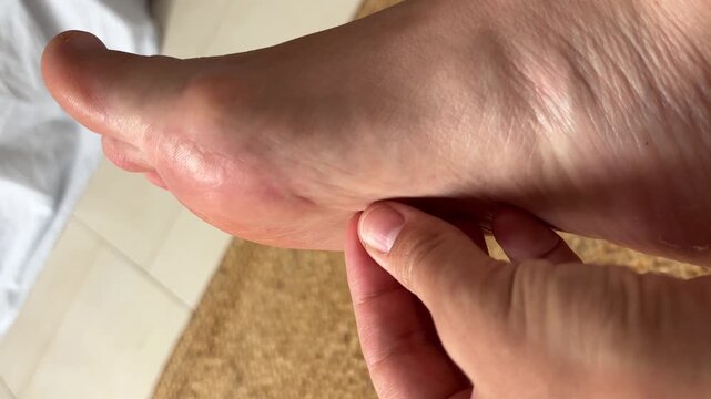 A close up of a person's foot with a wooden splinter in the sole, a small piece of wood piercing the skin, concept of pain, first aid, health