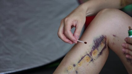 Post operative wound treatment. Close-up shot of patient legs. 4K