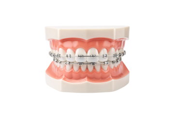 Full dental model showing blue braces on upper and lower teeth, isolated on a transparent background
