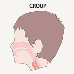 Croup vector illustration: shows barking cough, noisy breathing, hoarse voice, fever. Highlights comparison with asthma, bronchitis, epiglottitis for quick symptom differentiation.