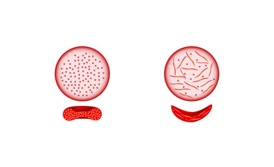 Sickle cell disease. Normal blood and Sickle cell anemia. Gene mutation. Vector illustration.	