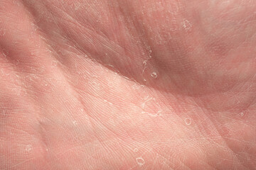 Naklejka premium Macro shot of a human palm with visible dry skin and peeling texture, illustrating dermatology, skin problems, healthcare, and personal care