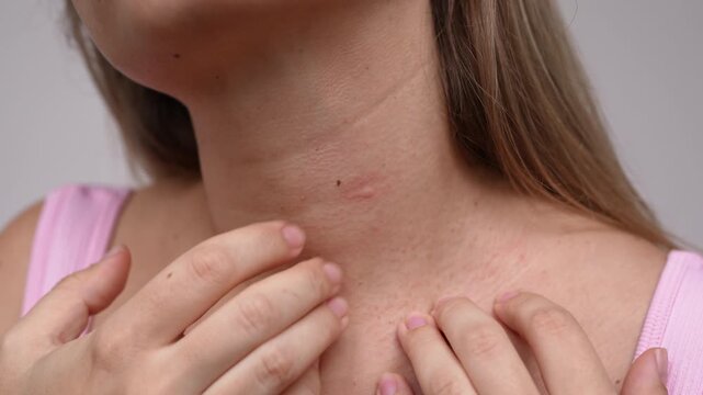 Close-up of young woman scratching a mosquito bite on her neck. Visible irritation, red spot, discomfort, insect bite reaction, skincare issue