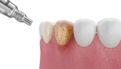 Dental restoration treatment for damaged tooth, gold filling application close up