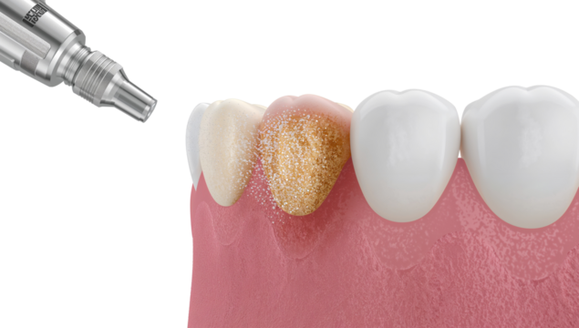 Dental restoration treatment for damaged tooth, gold filling application close up