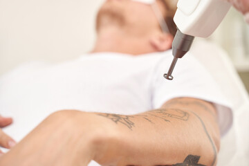 Young caucasian male receiving tattoo removal procedure with laser device in clinical setting.