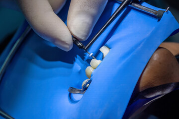 Dentist’s hands inserting a dental file into a tooth during root canal treatment with rubber dam isolation. Concept of endodontics, precision work, and patient care.