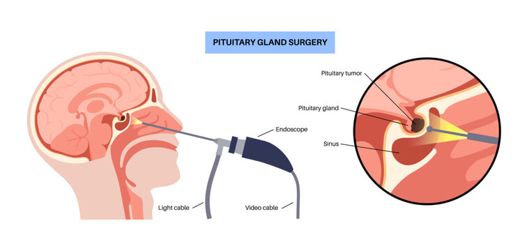 Pituitary gland surgery