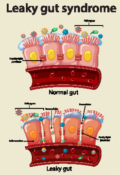 Comparison of Normal Gut and Leaky Gut Syndrome